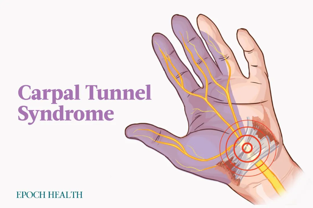 Carpal tunnel syndrome is a common neurological condition caused by compression of the median nerve. (Illustrations by The Epoch Times, Shutterstock)