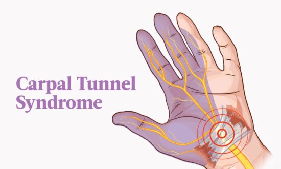 The Essential Guide to Carpal Tunnel Syndrome