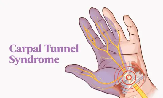 Carpal Tunnel Syndrome: Symptoms, Causes, Treatments, and Natural Approaches