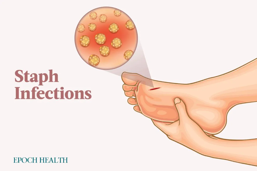 There are over 30 types of staph bacteria, some of which are resistant to antibiotics. (Illustrations by The Epoch Times, Shutterstock)