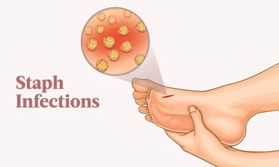 Staph Infections: Symptoms, Causes, Treatments, and Natural Approaches