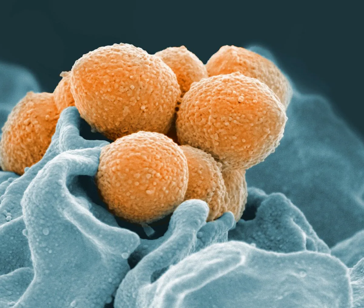 An electron microscope image shows Group A Streptococcus in orange. (The Canadian Press/AP-NIAID via AP)
