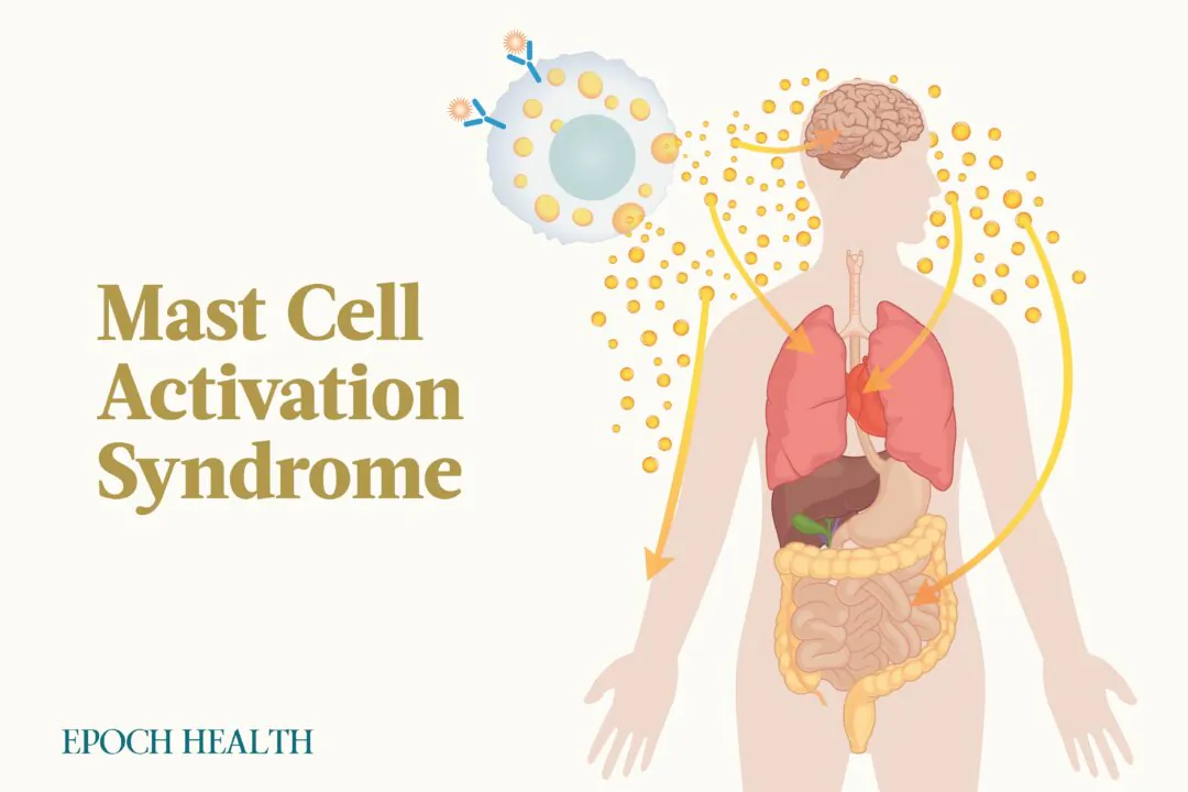 Mast cell activation syndrome may affect up to 17 percent of the global population, according to some experts. (Illustrations by The Epoch Times, Shutterstock)