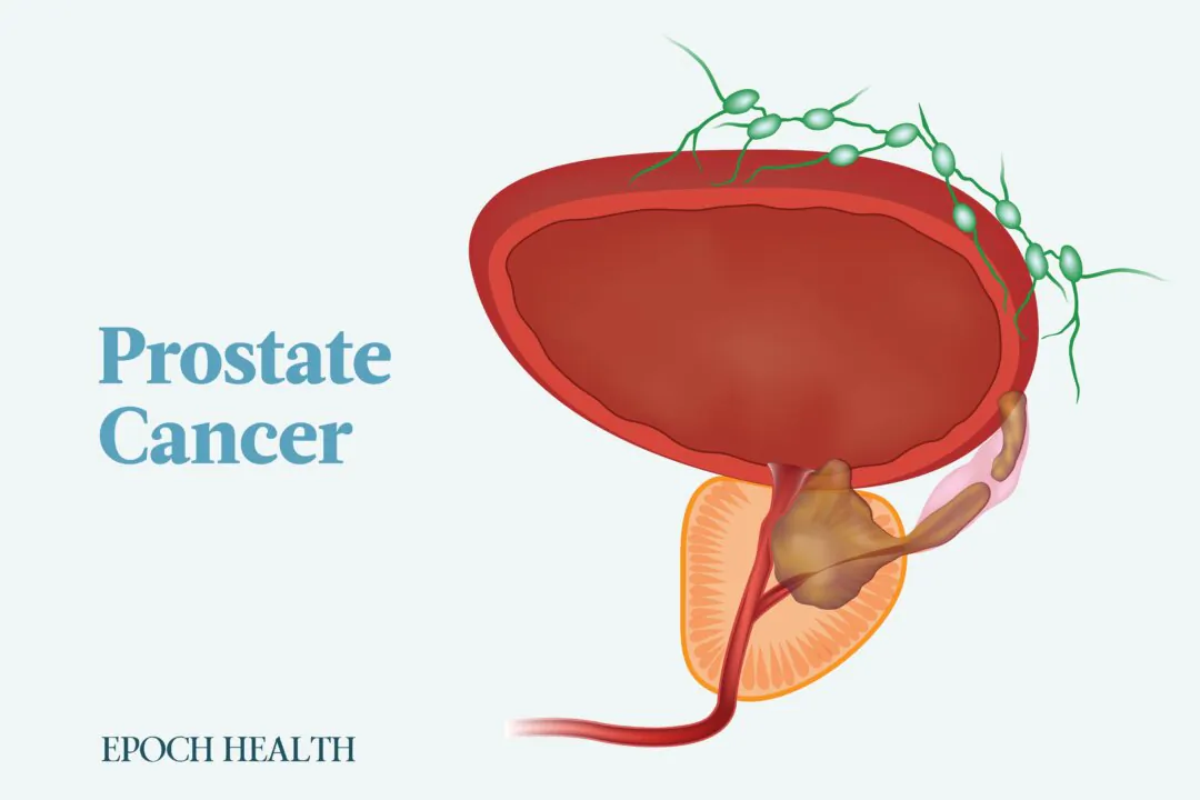 Signs of prostate cancer typically don't appear until advanced stages. (Illustrations by The Epoch Times, Shutterstock)