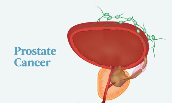 The Essential Guide to Prostate Cancer: Symptoms, Causes, Treatments, and Natural Approaches