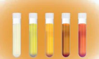 Urine Colors May Be Warning Signs of Diseases, Here’s How to Tell