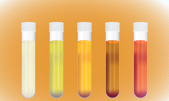 These Urine Colors Are Warning Signs of Diseases
