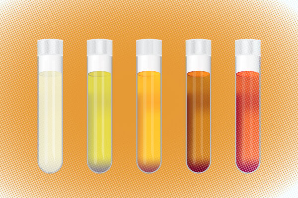 These Urine Colors Are Warning Signs of Diseases