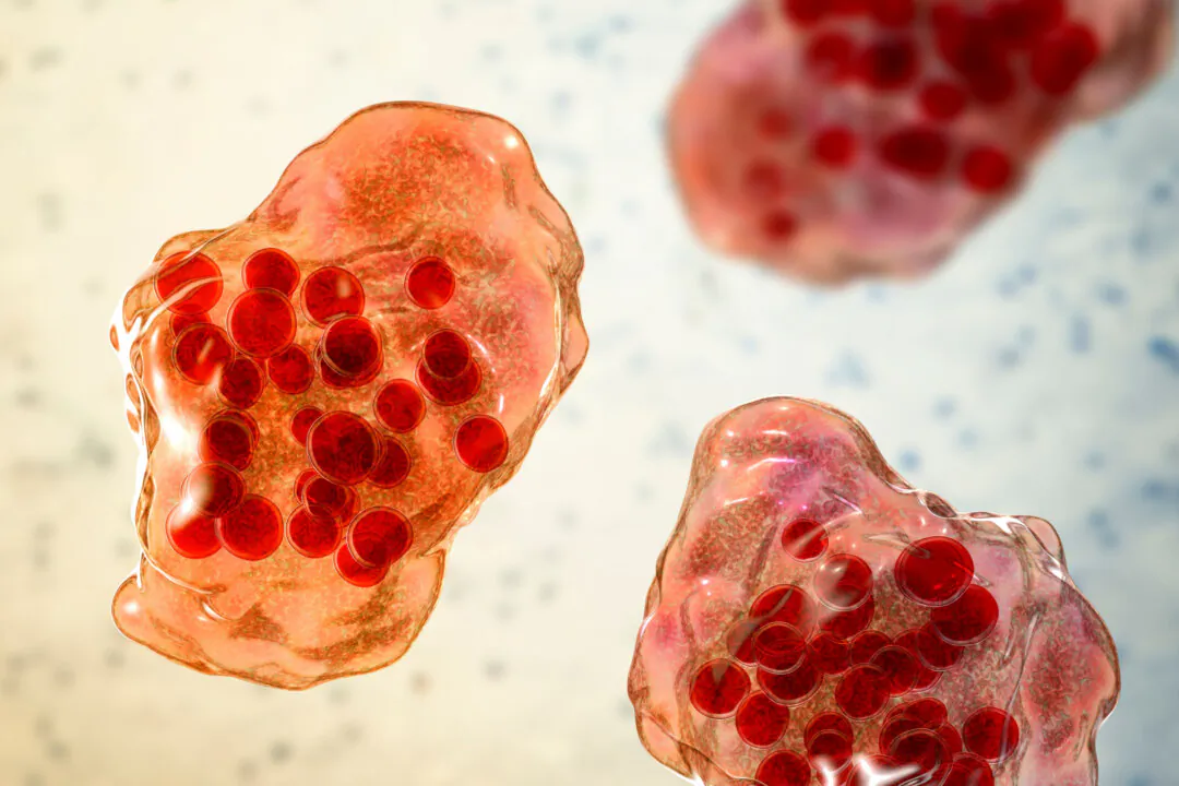 Measles disease, giant multinucleated cells seen during microscopy of biopsy specimens, known as Warthin-Finkeldey giant cells. (Kateryna Kon/Shutterstock)