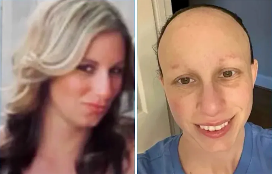 Before and after photos of Lyndsey House, a health care worker who was injured by the Pfizer COVID-19 vaccine (Courtesy of Lyndsey House).