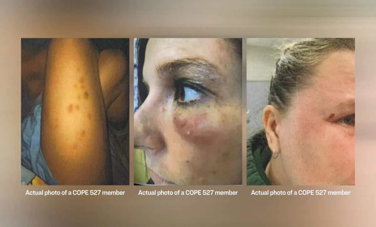 Hamilton educators with the Canadian Office and Professional Employees (COPE) union Local 527 are shown with bruises as a result of violence at school. (Courtesy of COPE 527)
