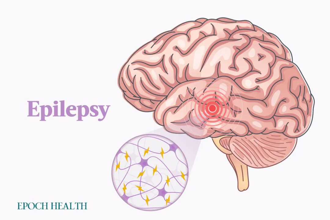 Epilepsy is a condition wherein a person experiences recurrent seizures. (Illustrations by The Epoch Times, Shutterstock)