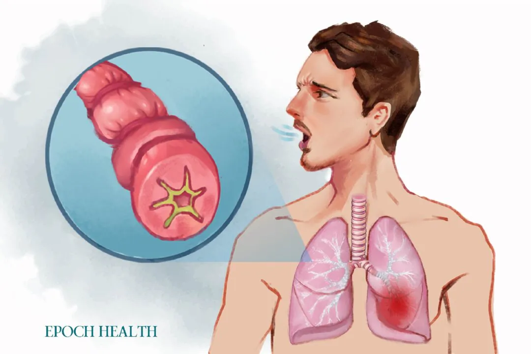 There is no cure for asthma, but symptoms can be managed with proper treatment. (Illustrations by The Epoch Times, Shutterstock)
