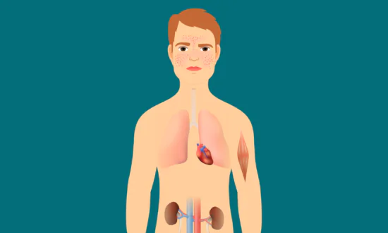 6 Therapeutic Exercises to Help You Manage Lupus