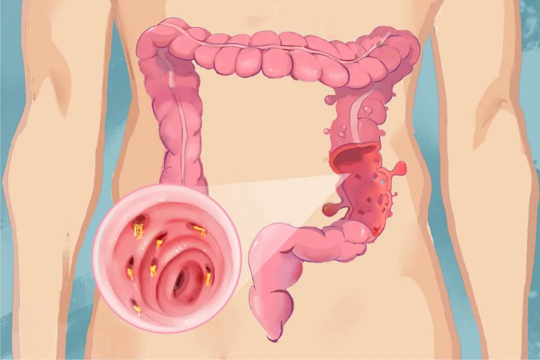 Though the development of diverticula is not uncommon, less than 5 percent of those with diverticulosis develop diverticulitis. (The Epoch Times)