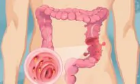 Diverticulitis: Symptoms, Causes, Treatments, and Natural Approaches