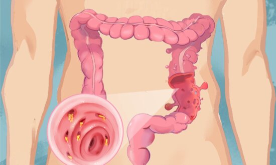 Major Cause of Diverticulitis—Be Aware