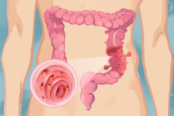 Diverticulitis: 7 Main Symptoms and 4 Treatment Approaches