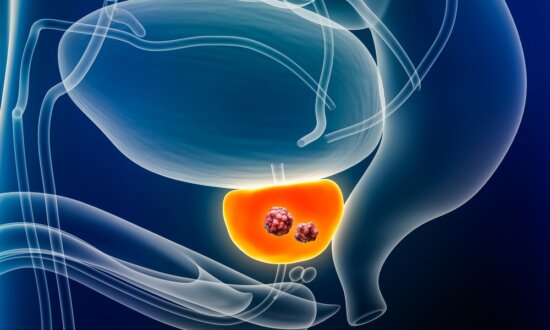 Who Should Undergo Routine Prostate Cancer Screenings?