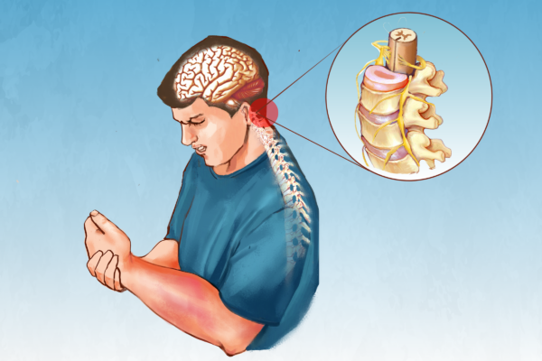 Complex Regional Pain Syndrome: Symptoms, Causes, Treatments, and Natural Approaches