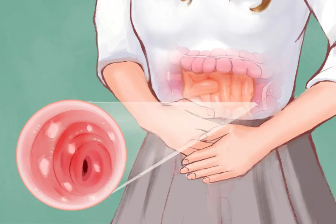 Symptoms of ulcerative colitis can extend beyond the intestinal tract. (Illustration by The Epoch Times)