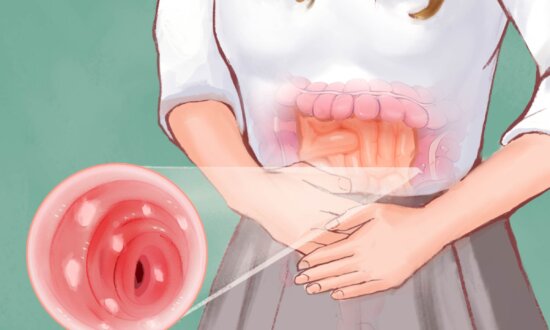 Ulcerative Colitis: Symptoms, Causes, Treatments, and Natural Approaches