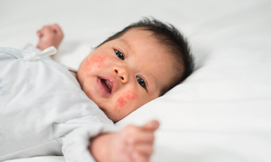 Childhood Eczema May Hinder Brain Development: Study