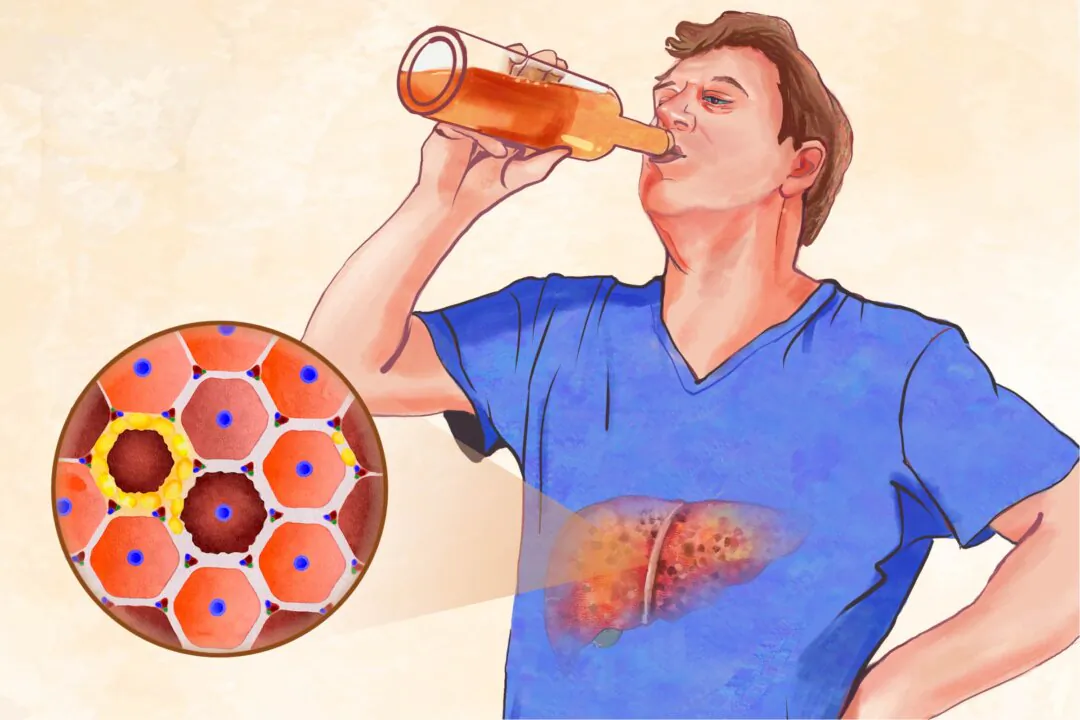 Cirrhosis is permanent scarring of the liver and a later stage of liver disease. (Illustration by The Epoch Times, Getty Images)