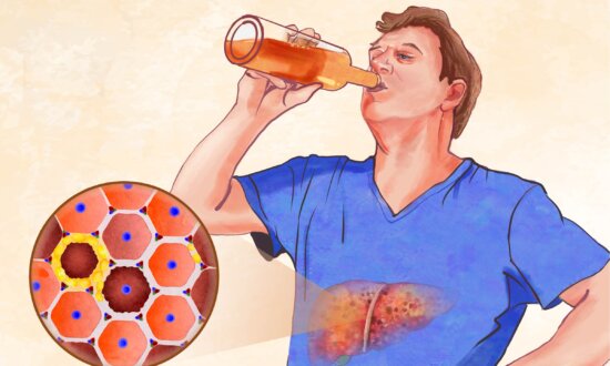 The Essential Guide to Cirrhosis: Symptoms, Causes, Treatments, and Natural Approaches