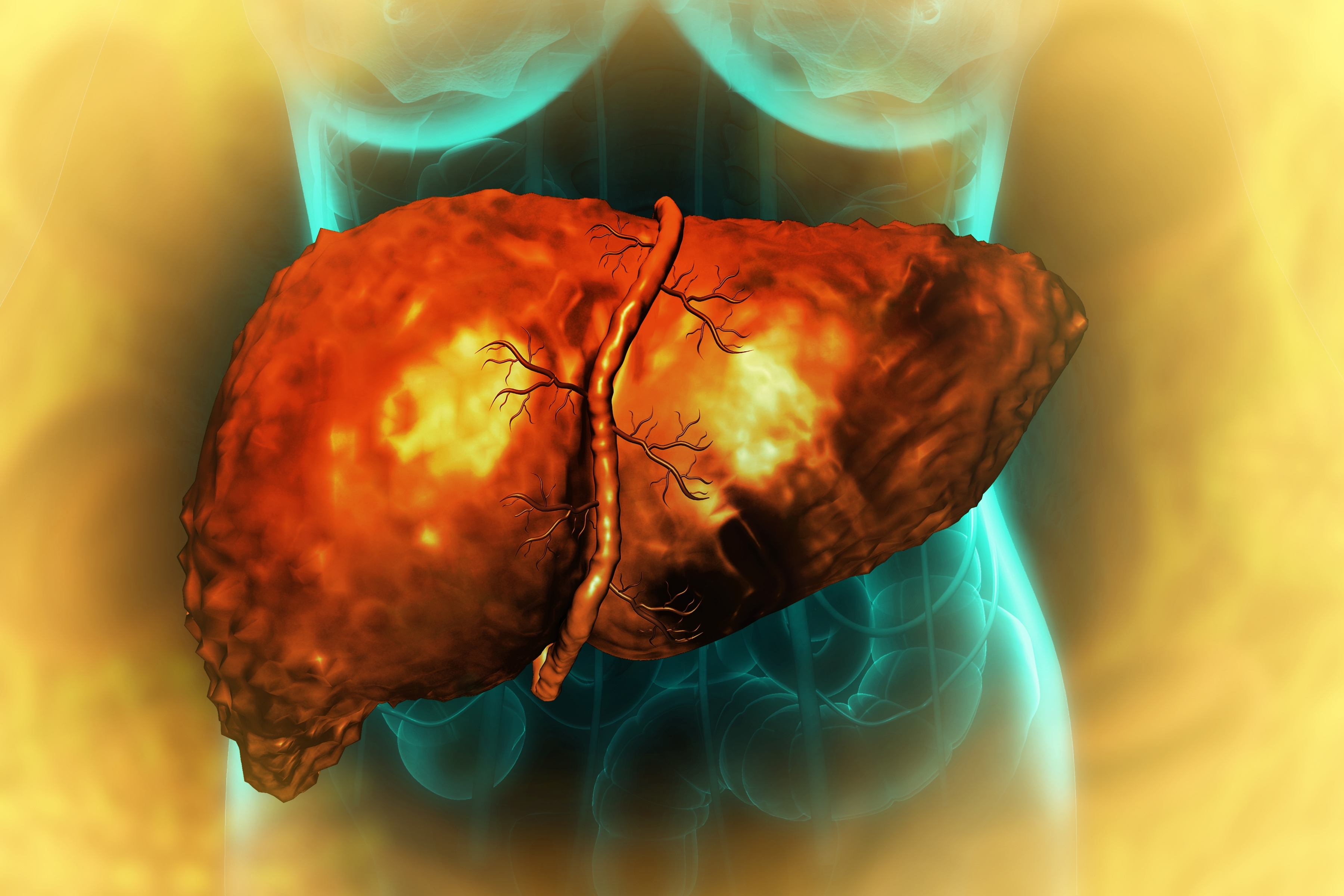 Major Cause of a Silent, Deadly Liver Disease