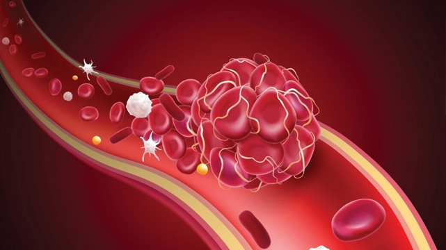 Spike Protein Exposure and Clotting Pathologies Explained