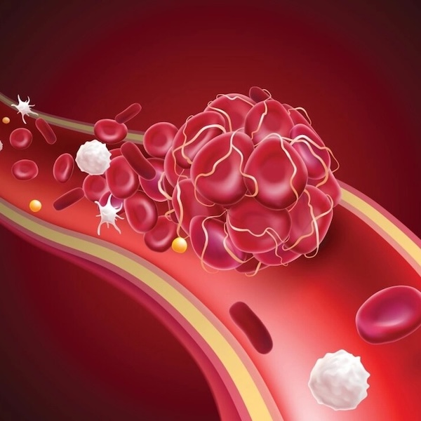 Spike Protein Exposure and Clotting Pathologies Explained