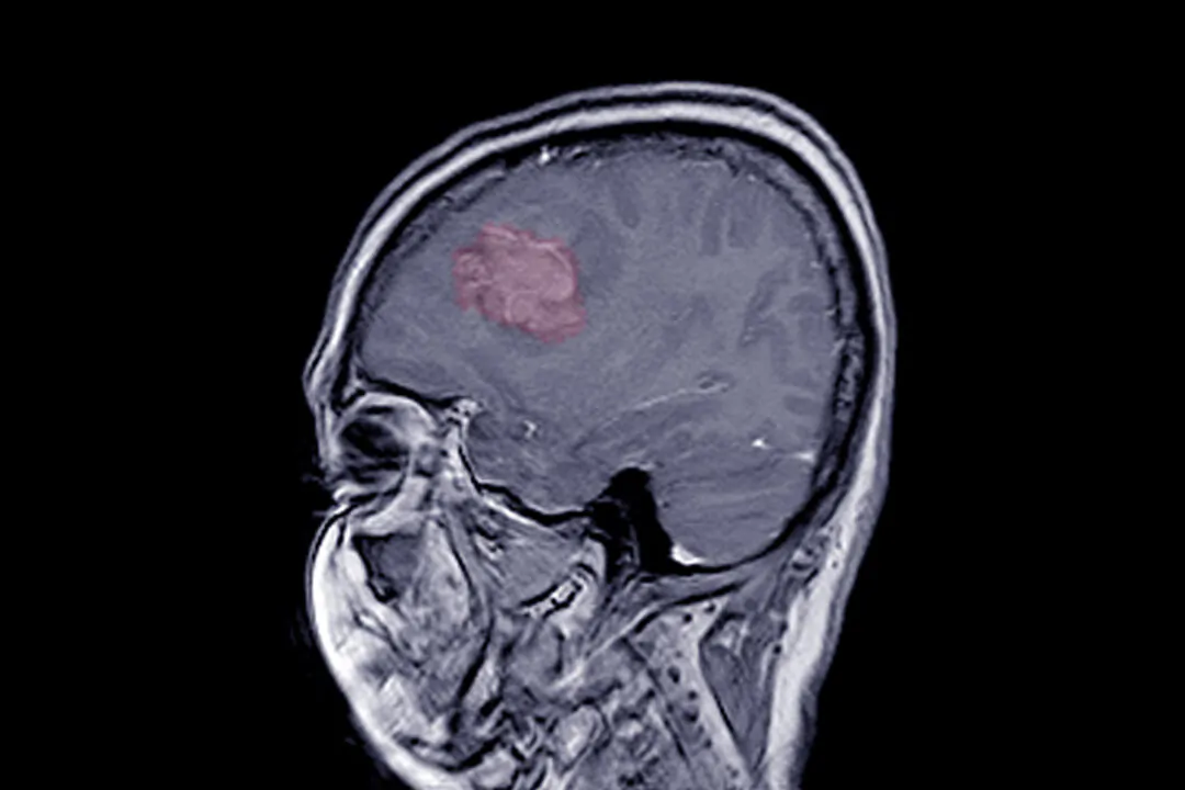 An MRI finding of meningioma. (April stock/Shutterstock)
