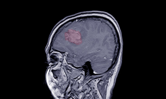 Certain Progestogens Linked to Higher Risk of Brain Tumors