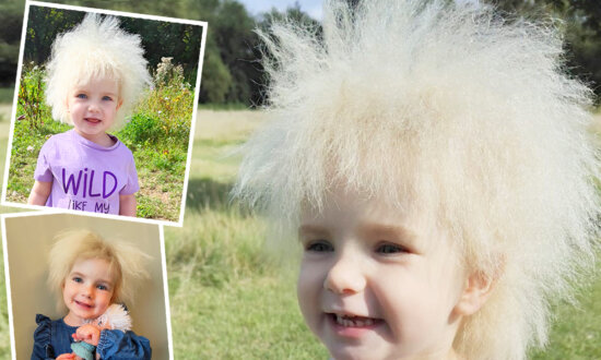 Girl With Frizzy Hair Nicknamed 'Fluffy' by Friends—She's One of Only 100 People in the World With This Syndrome