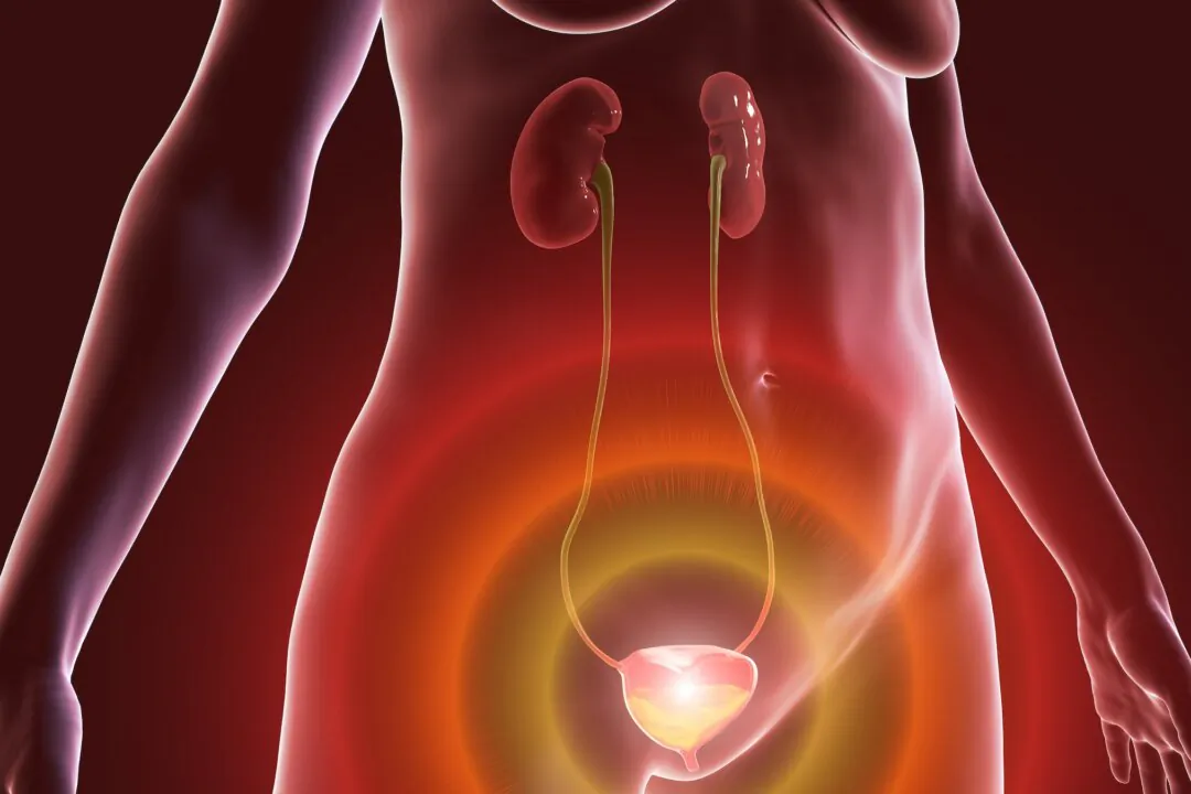 Overactive urinary bladder in a female, 3D illustration. A condition where there is a frequent feeling of needing to urinate, sometimes with loss of bladder control leading to urge incontinence