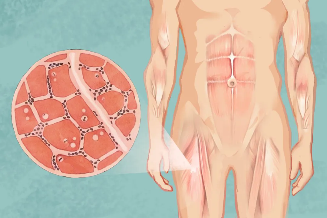 Inclusion body myositis is an insidious disease that leads to muscle weakness and atrophy. (Illustration by The Epoch Times, Shutterstock)