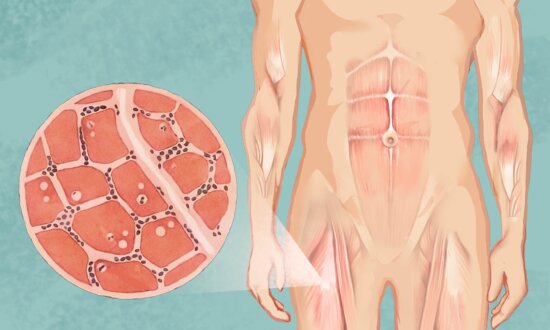 Inclusion Body Myositis: Symptoms, Causes, Treatments, and Natural Approaches