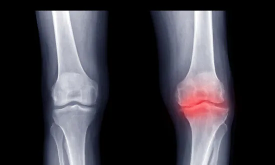 Pulsed Electromagnetic Field Therapy May Relieve Osteoarthritis: Study