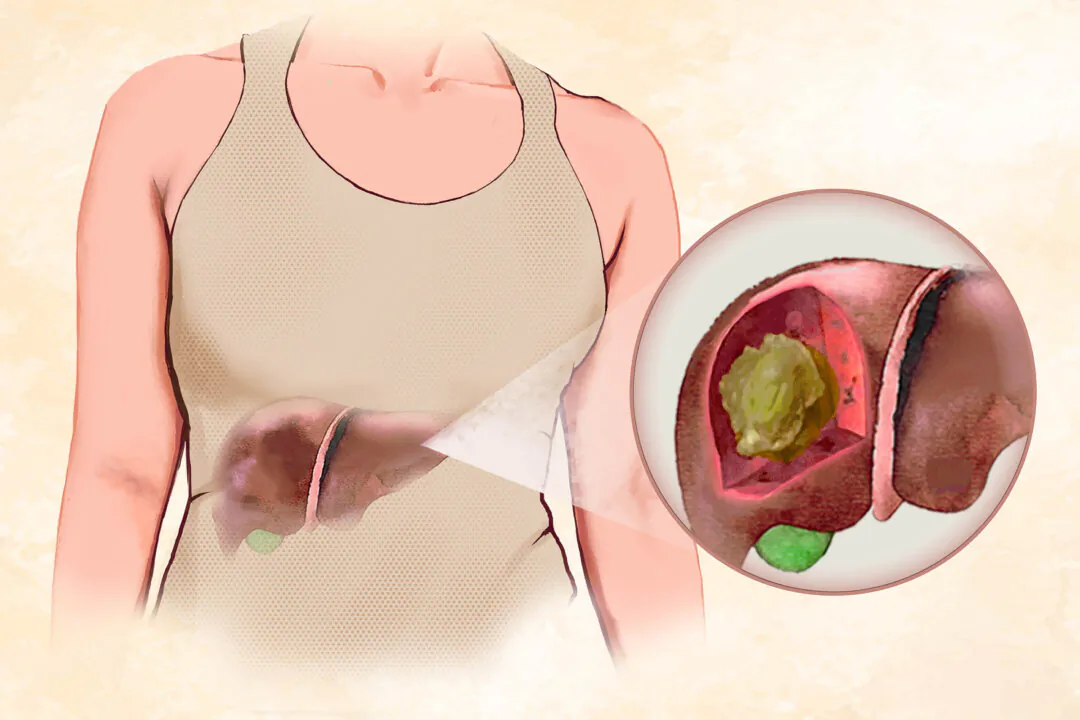 Liver cancer ranks among the top causes of cancer-related deaths globally. (Illustration by The Epoch Times, Getty Images)