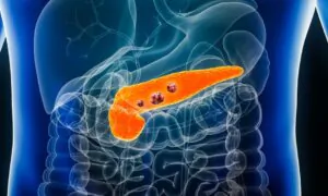 Potential Early Signs of Pancreatic Cancer: Insights From Clinical Cases