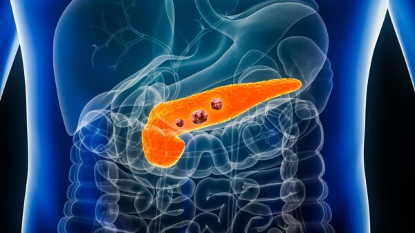 Early Warning Signs of Pancreatic Cancer