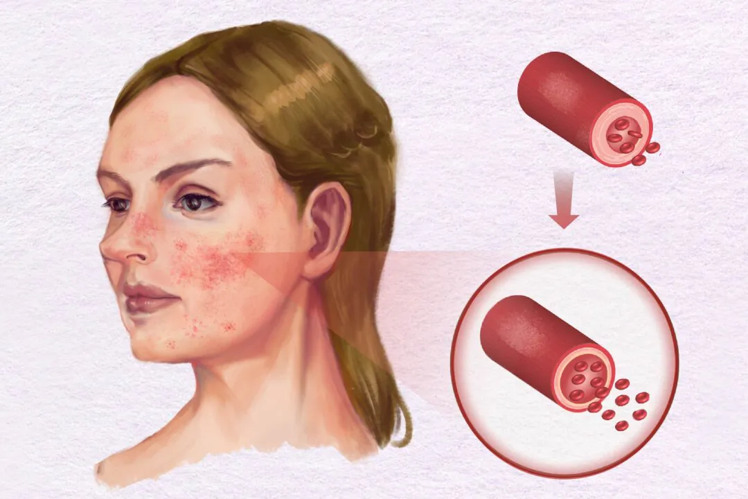 Rosacea causes facial redness, pustules, papules, and skin thickening. (Illustration by The Epoch Times, Shutterstock)