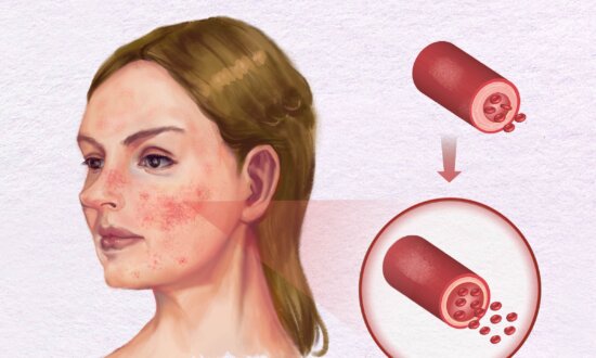 Main Causes of Rosacea