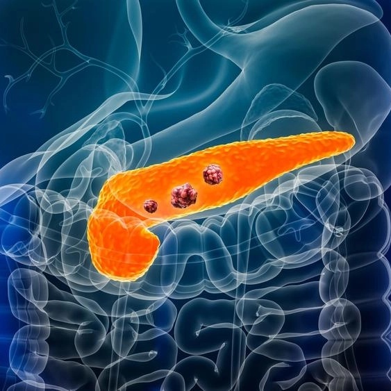 Early Warning Signs of Pancreatic Cancer