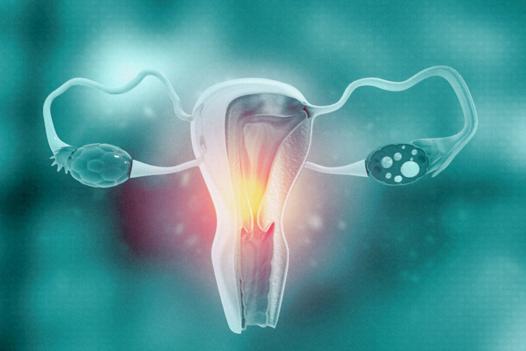 Majority of Women With Uterine Fibroids Steered to Sterilization