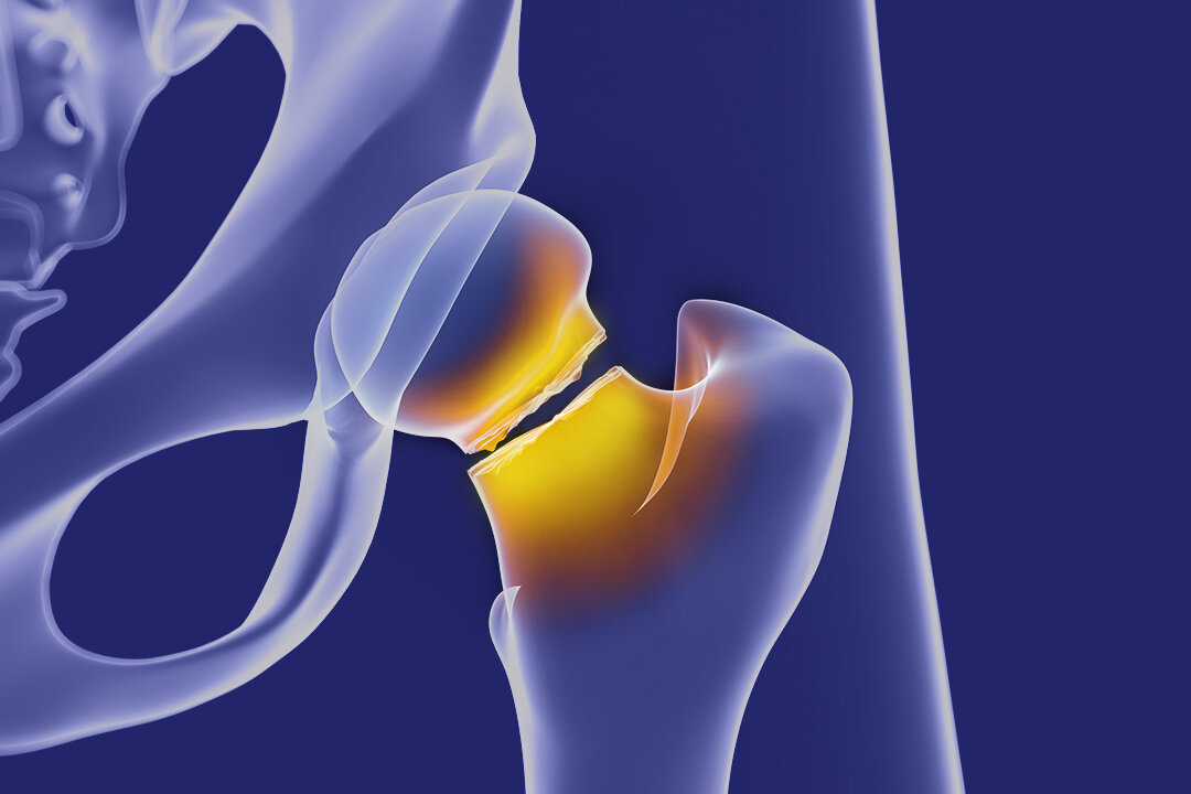 5 Therapist-Recommended Exercises to Combat Osteoporosis