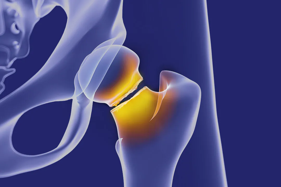 5 Therapist-Recommended Exercises to Combat Osteoporosis