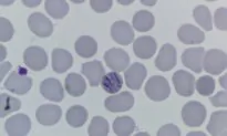 Southeastern Ontario Health Unit Probes 114 Cases of Parasitic Stomach Illness