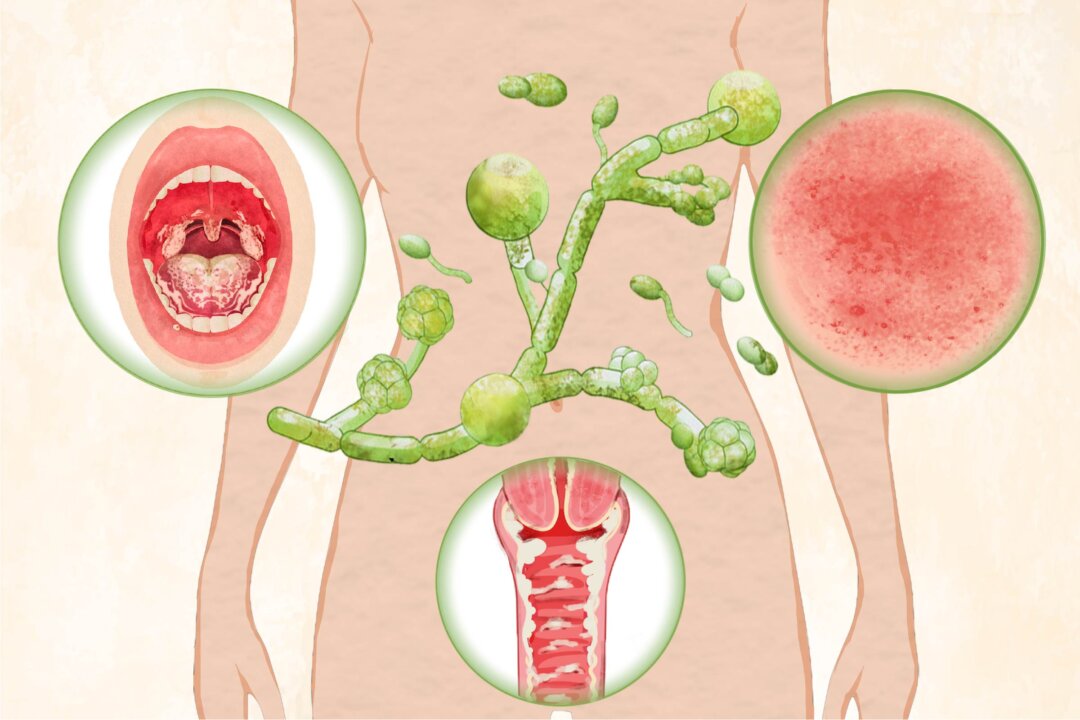 Yeast Infection: Symptoms, Causes, Treatments, and Natural Approaches - Vimarsana News
